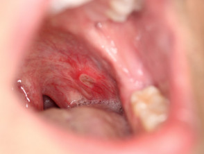 Oral Crohn disease