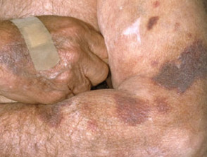 Steroid atrophy