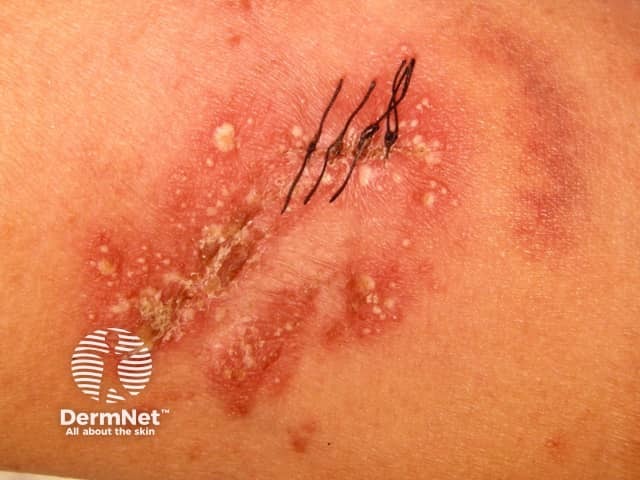 Localised pustular psoriasis induced by superpotent topical steroid