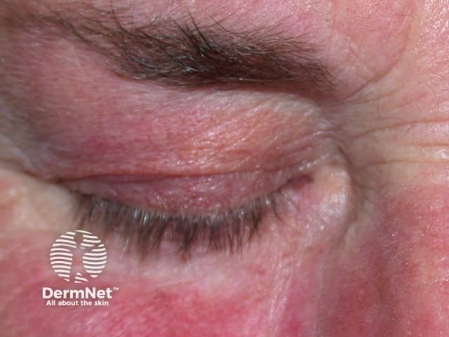 Prominent capillaries due to topical steroids