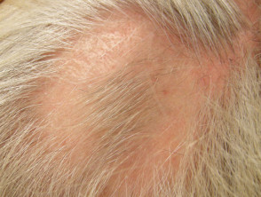 Intralesional steroid injection for alopecia areata