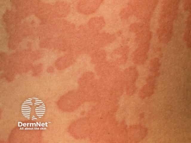 Spontaneous urticaria