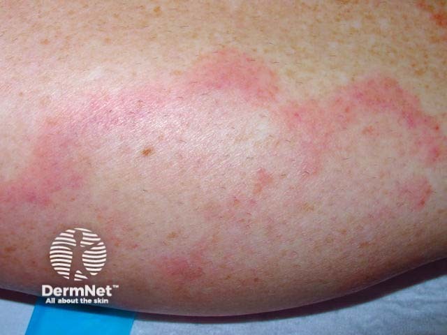 Urticarial vasculitis