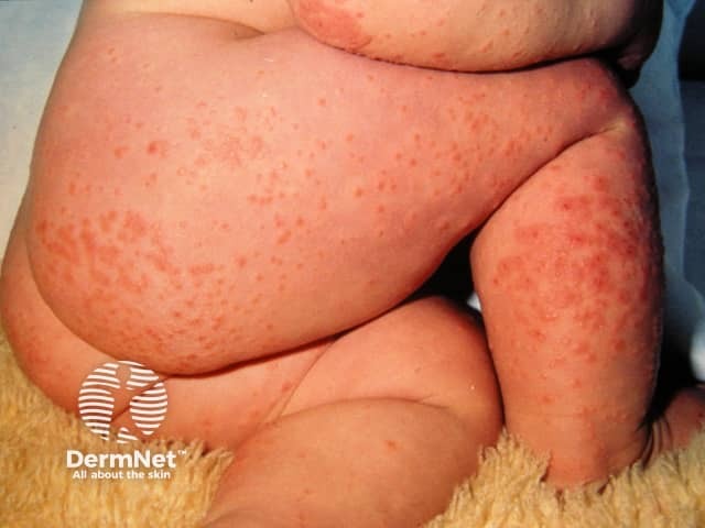 Infantile papular acrodermatitis