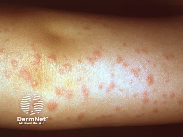 Infantile papular acrodermatitis