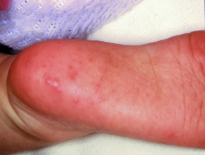 Hand foot and mouth disease