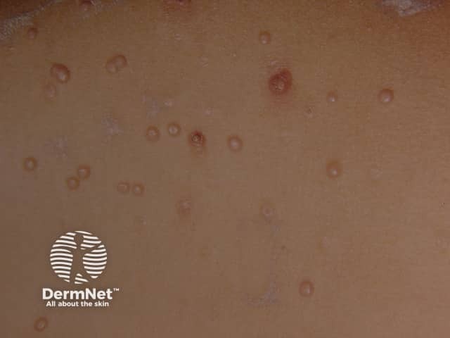 Molluscum contagiosum