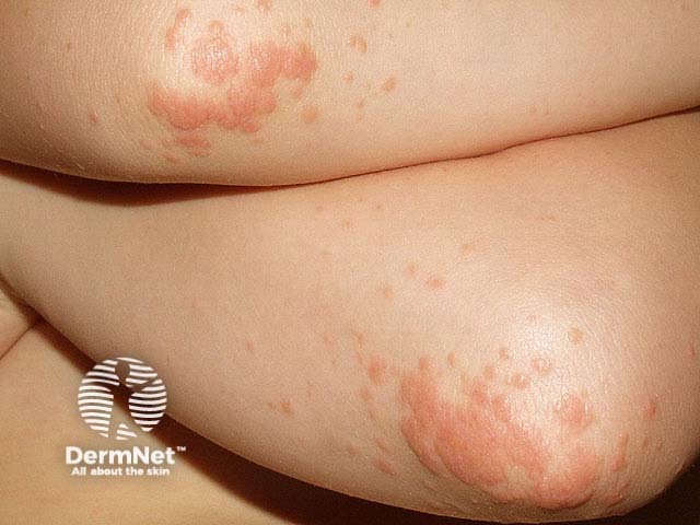 Infantile papular acrodermatitis