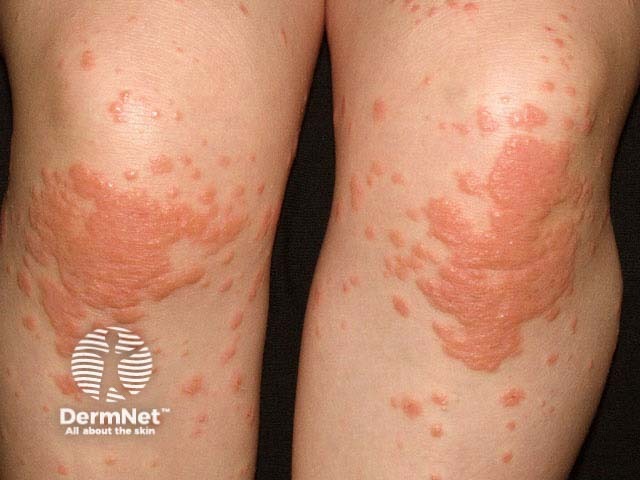 Infantile papular acrodermatitis