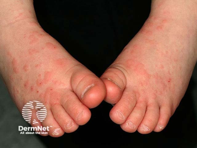 Infantile papular acrodermatitis