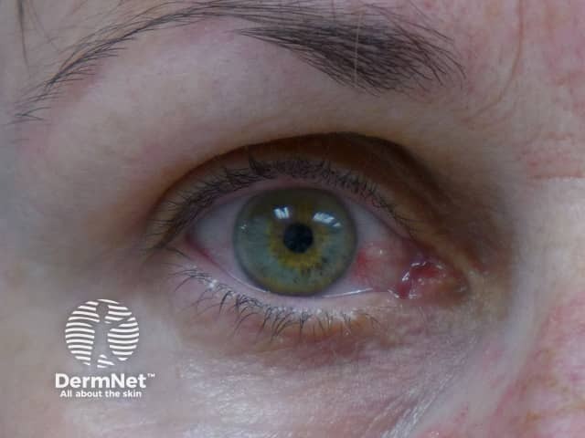 Zika virus infection