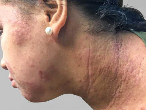 Atopic dermatitis of the face and neck in a teenager with skin of colour