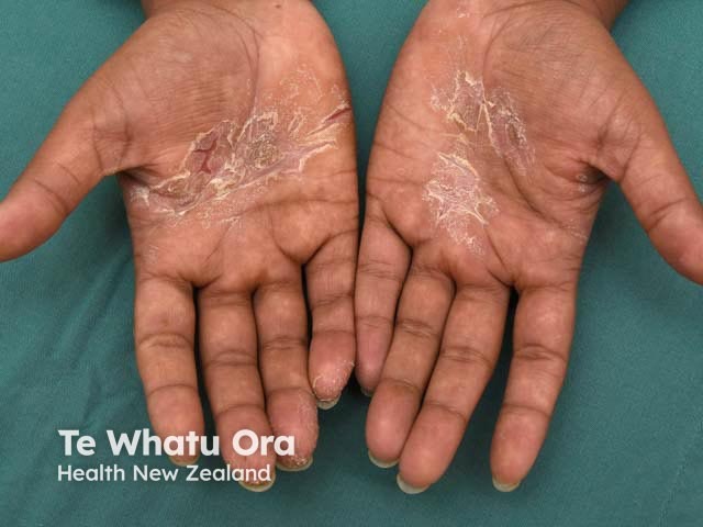 Hyperkeratotic palmar eczema