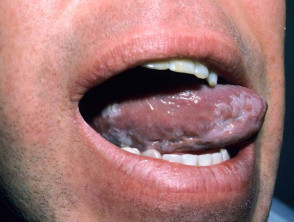 oral hairy leukoplakia 00005