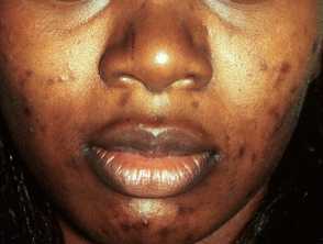 Acne scarring