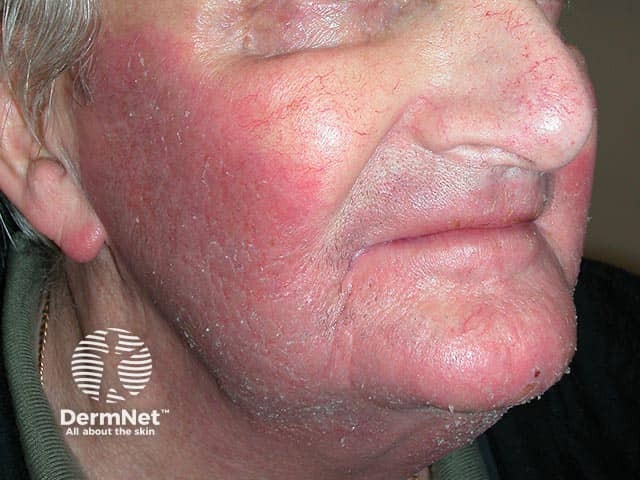 Allergic contact dermatitis on the face due to imidazolidinyl urea in a sunscreen