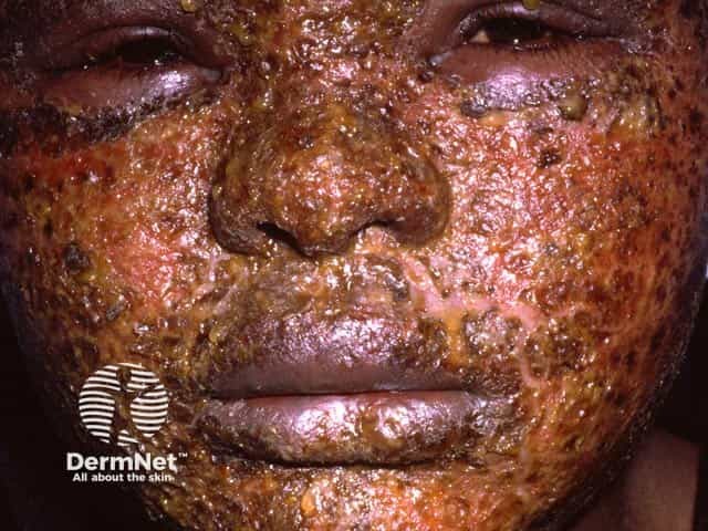 Severe acute allergic contact dermatitis - lanolin was the culprit