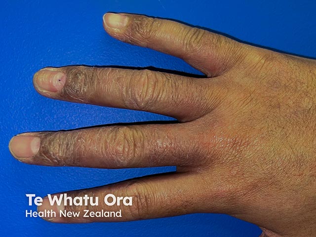 Allergic contact dermatitis resulting in scaling, redness and fissuring on the backs of the fingers