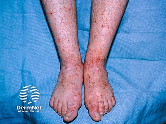 Contact allergy to a military boot - chromate, rubber, and footwear adhesives are common causes