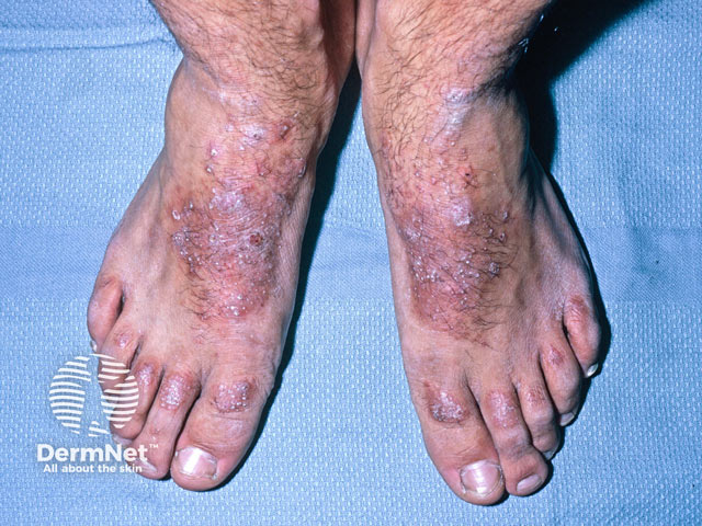 Chronic footwear dermatitis