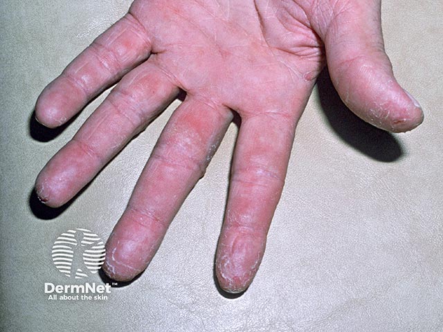 Occupational allergic contact dermatitis due to acrylate 'super glue' use