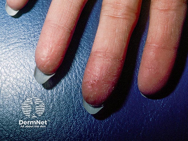 Allergic contact dermatitis from bowling ball