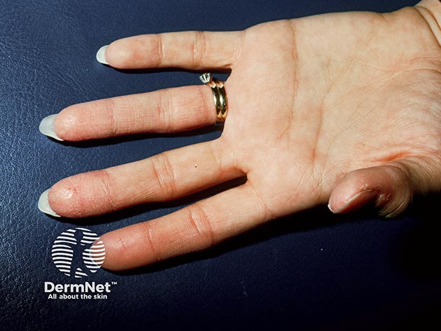 Allergic contact dermatitis from bowling ball