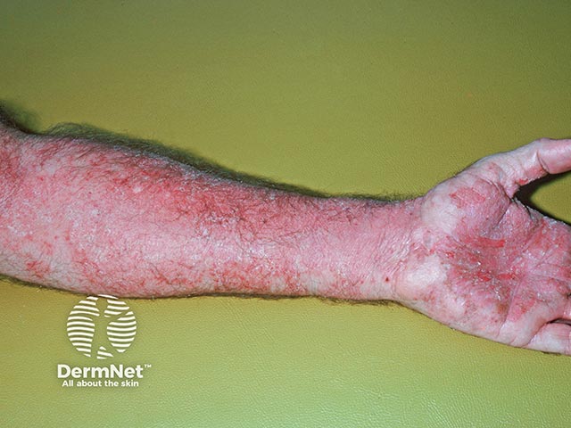 Allergic contact dermatitis in a builder due to chromate in cement