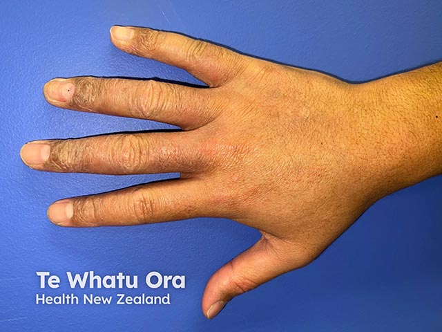 Contact allergy from a glove