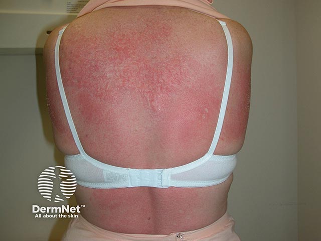 Acute contact allergy to dimethyl fumarate - the 'Chinese sofa dermatitis' allergen