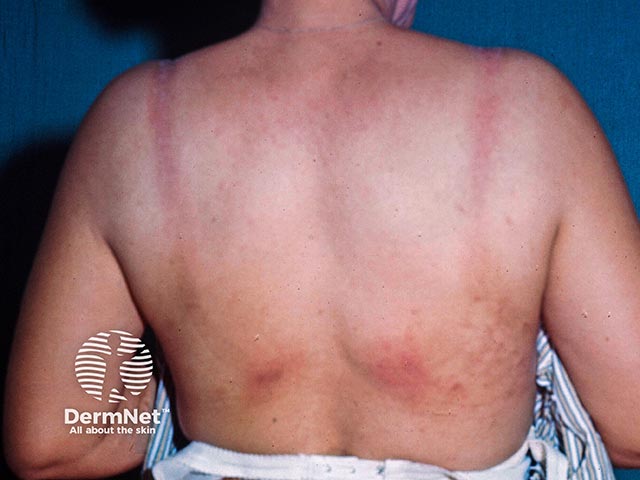 Contact allergy to a bra constituent