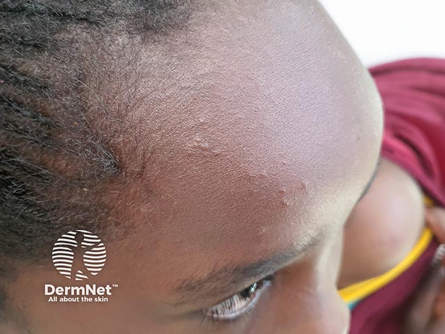 Contact allergy on the forehead due to a dye in a hat