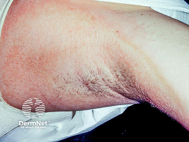 Contact allergy to a deodorant constituent