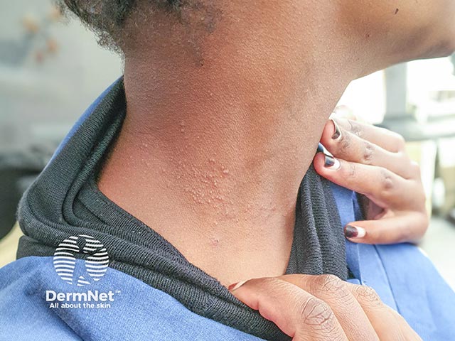 Neck dermatitis from a nickel necklace