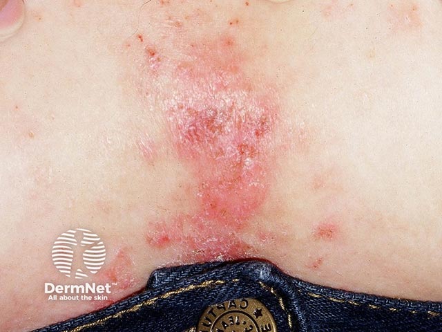 Contact dermatitis due to nickel in a jeans stud