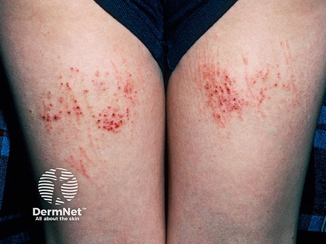 Contact allergy on the backs of the thighs due to nickel in a chair