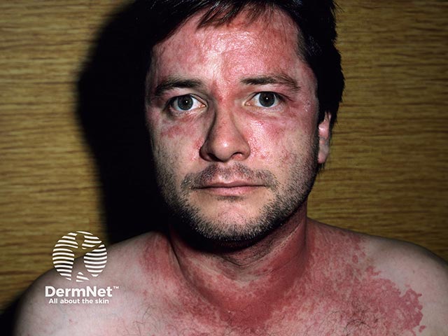 Facial and chest eczema - allergic contact dermatitis from rosewood dust