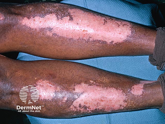 Contact allergy to a cosmetic camouflage constituent used to disguise vitiligo