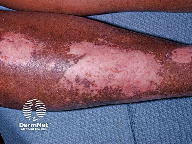 Contact allergy to a cosmetic camouflage constituent used to disguise vitiligo