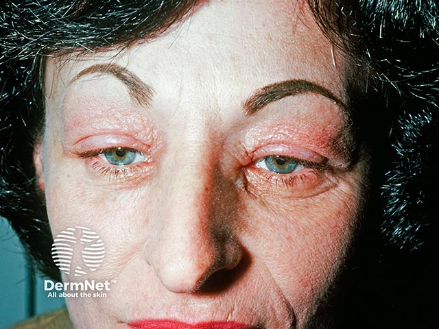 Facial contact dermatitis due to a cosmetic constituent