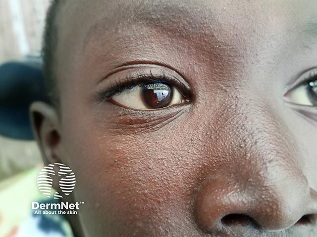 Contact dermatitis on the face due to a herbal face soap