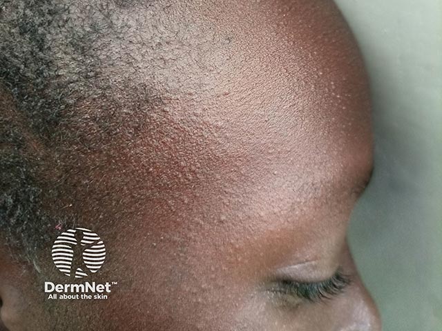 Contact allergy on the face and forehead due to a herbal soap constituent