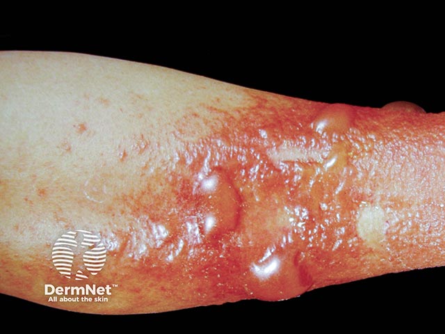 Allergic contact dermatitis from an antihistamine cream