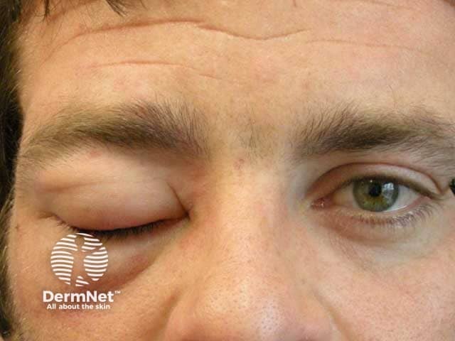 Unilateral lid angiodema