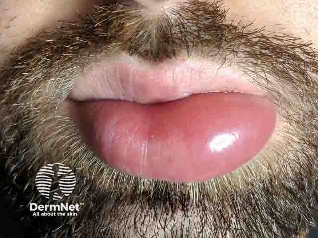 Lip angiodema