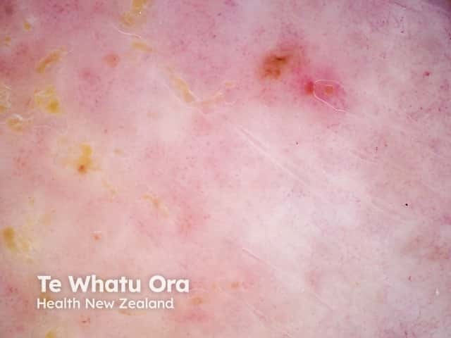 Atopic eczema dermoscopy showing clusters of dotted vessels