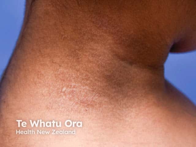 Lichenification and hyperpigmentation - sometimes called