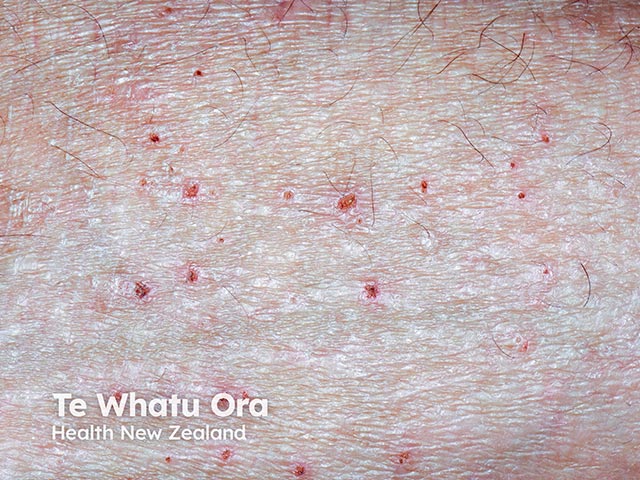 Close-up of erythematous papules and scratch marks in lichenified atopic dermatitis