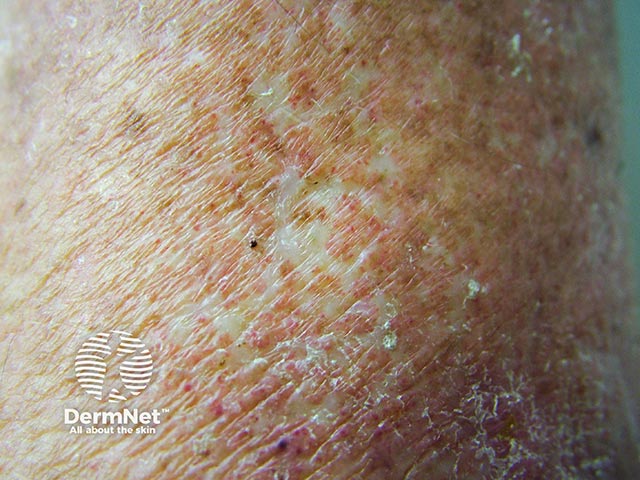 Close-up of atrophie blanche
