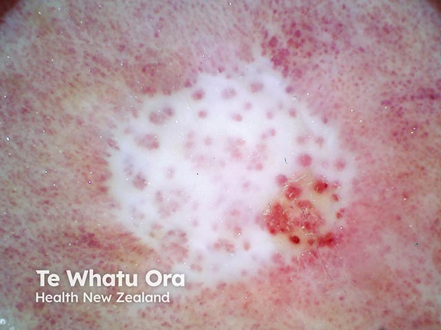 Dermoscopy of atrophie blanche - ivory white scarring and central dot vessels